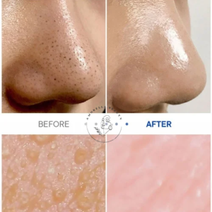 سرم لایه‌بردار جوش‌های سرسیاه بینی One-day's You حجم 100 میل